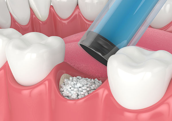 Dental implant procedure showing bone graft material being placed in jawbone gap between teeth.