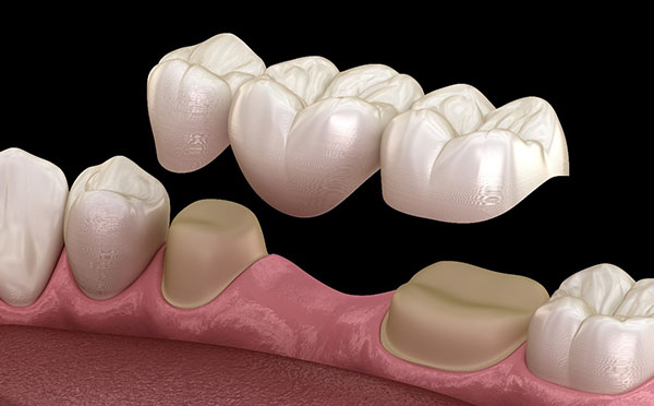 Dental bridge model showing tooth replacement prosthetic on pink gum model against black background.