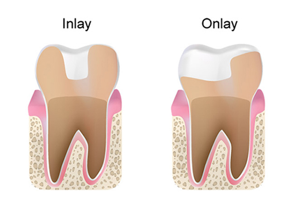 Inlay and onlay dental restorations compared showing tooth restoration placement methods.