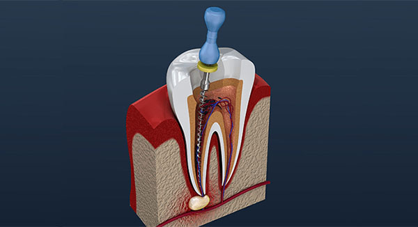 Dental implant cross-section showing tooth structure, root, and surgical placement in jawbone.