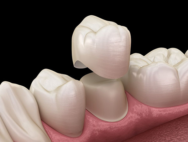 Dental crowns placed on tooth models demonstrating restorative dentistry procedure and crown placement.