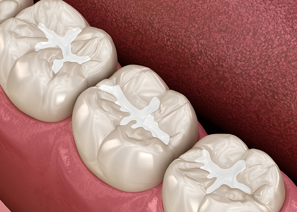 Three white dental crowns displayed on pink gum model showing occlusal surface detail.